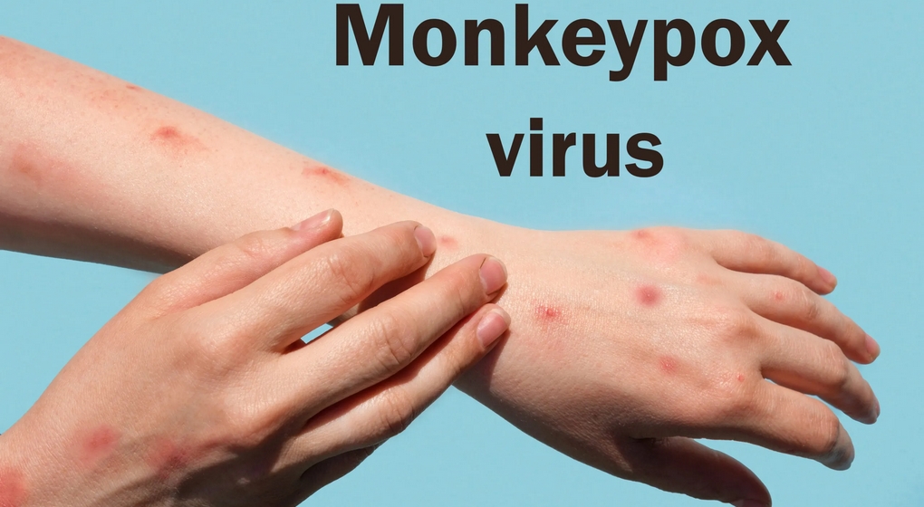 Variole du singe - CHU Saint-PIerre