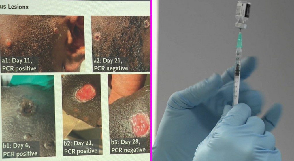 Variole du Singe Vaccin - Montage BX1