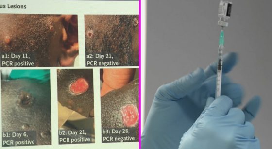 Variole du Singe Vaccin - Montage BX1